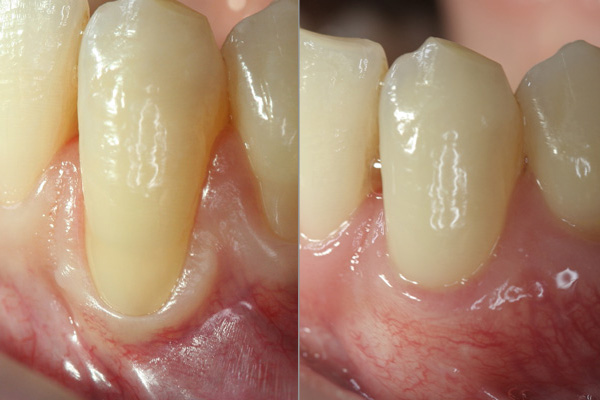 Healing Time Example 1