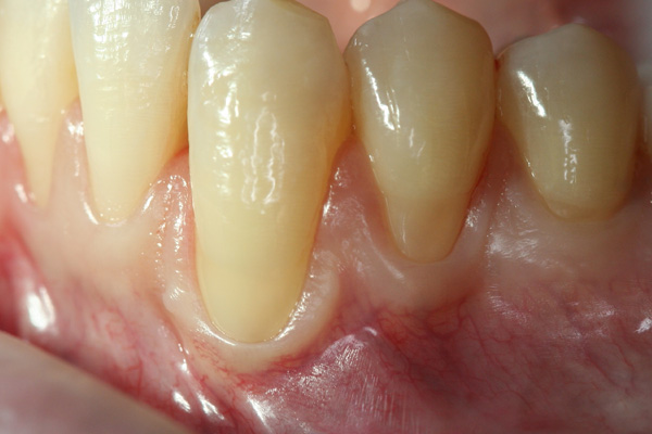 Healing Time Example 1