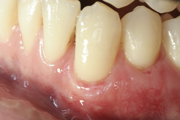 Healing Time Example 2