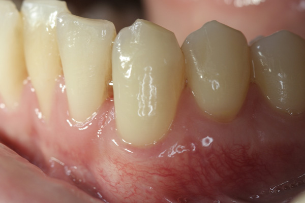 Healing Time Example 3