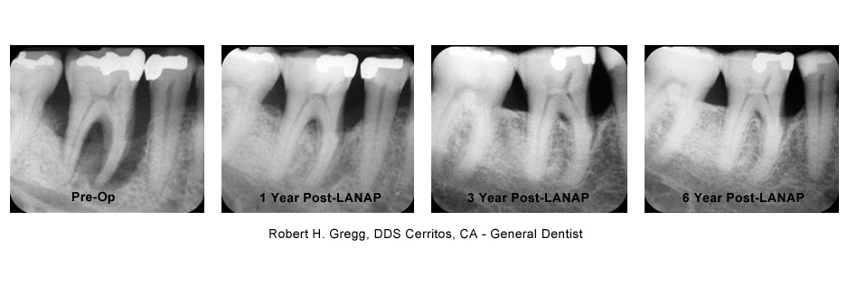 Comparison X-Ray from pre-treatement through 6 years post-treatment