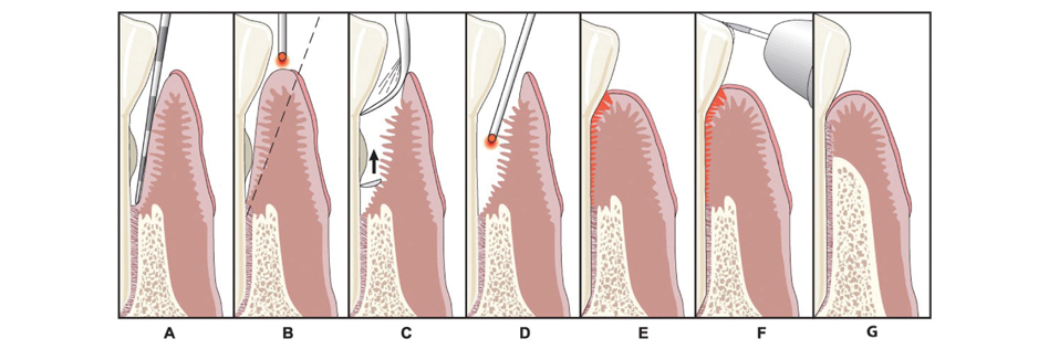 Diagram on how LANAP Works