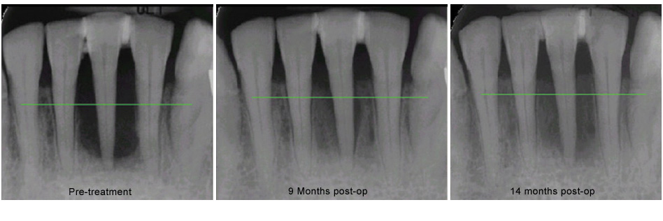 Comparison X-Ray from pre-treatement through 14 months post-treatment