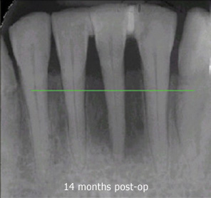 Comparison X-Ray from pre-treatement through 14 months post-treatment