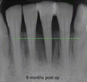 Comparison X-Ray from pre-treatement through 14 months post-treatment