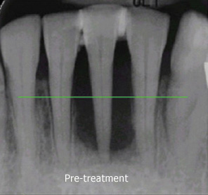 Comparison X-Ray from pre-treatement through 14 months post-treatment