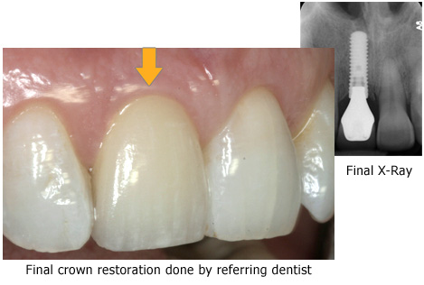 Implants Pre & Post Op