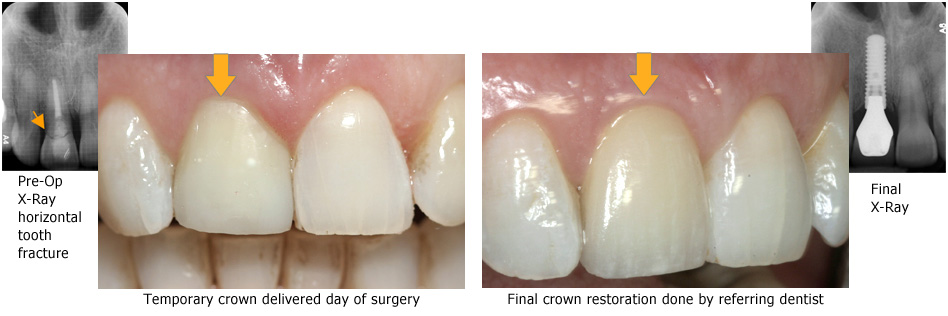 Implants Pre & Post Op