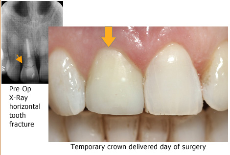 Implants Pre & Post Op