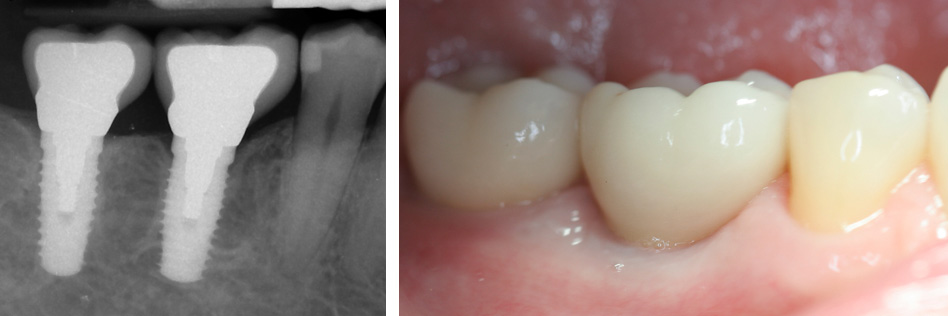 Pre-Operative and Post Operative Posterior